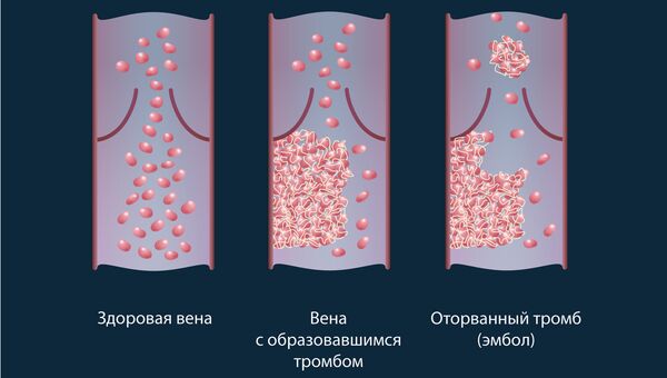Схема движения клеток с красителем в здоровых сосудах и сосудах с тромбами Схема движения клеток с красителем в здоровых сосудах и сосудах с тромбами